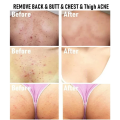 White Cream, Moisturizing Skin, Chicken Repair Cream, Buttocks, Back Acne, Body Acne Cream, Facial Sores, Smooth Marks.