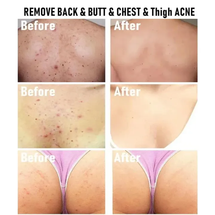 White%20Cream,%20Moisturizing%20Skin,%20Chicken%20Repair%20Cream,%20Buttocks,%20Back%20Acne,%20Body%20Acne%20Cream,%20Facial%20Sores,%20Smooth%20Marks%20-%20Image%202