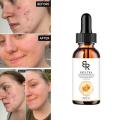 70% Glycolic Acid Chemical Peel Anti-Aging Brightening Smoothing Fine Lines Skin Pigmentation Acne Scars 30ml. 