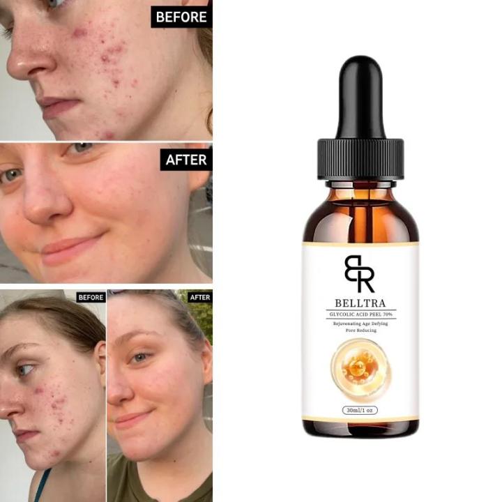 70%25%20Glycolic%20Acid%20Chemical%20Peel%20Anti-Aging%20Brightening%20Smoothing%20Fine%20Lines%20Skin%20Pigmentation%20Acne%20Scars%2030ml%20-%20Image%203