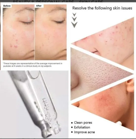 Salicylic%20Acid%202%25%20Solution%20(30ml)%20-%20Image%203