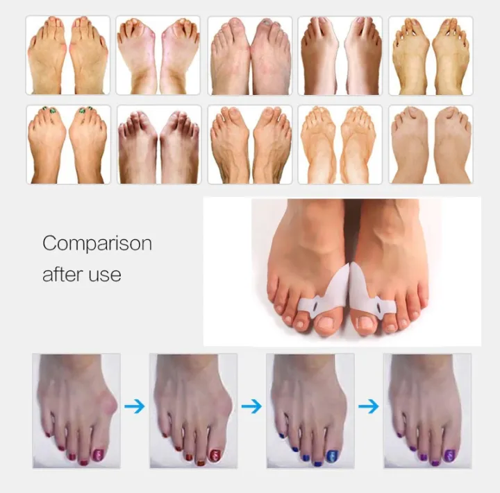 Big%20Toe%20Straightener%20Thumb%20Valgus%20Protector%20Silicone%20Gel%20Foot%20Fingers%20Toe%20Separator%20Bunion%20Adjuster%20Feet%20Pads%20Relief%20Foot%20Pain%20-%20Image%203
