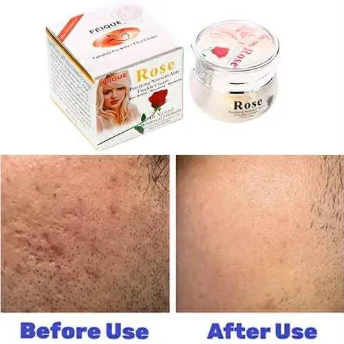 Feique%20Rose%20Essence%20Anti-freck%20Day%20and%20Night%20Cream%20-%20Image%205