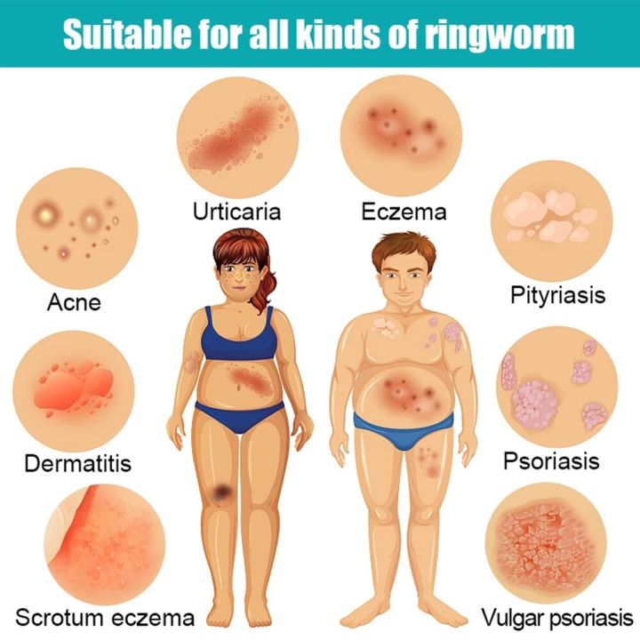 2pcs%20Natural%20Psoriasis%20Ointment%20Tinea%20Pedis%20Antibacterial%20Antipruritic%20Dressing%20Treat%20Dermatitis%20Eczema%20Skin%20Repair%20Care%20Cream%20-%20Image%205