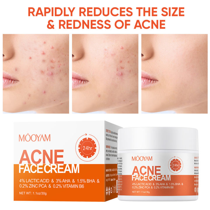 Acne%20Treatment%20Cream%20Anti%20Acne%20Face%20Cream%20Pimple%20Removal%20Spots%20Oil%20Control%20Shrink%20Pores%20Moisturizing%20Skin%20Care%20Cream%20-%20Image%204