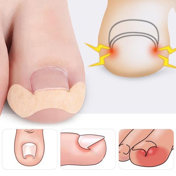 20-100pcs%20Professional%20Ingrown%20Toenail%20Foot%20Corrector%20Stickers%20Elasticity%20Toe%20Nail%20Care%20Pedicure%20Tools%20Toe%20Health%20Care%20Protects%20-%20Image%202