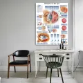 WANGART Poster Diseases of the Eye Chart Posters Refractiv Canvas print Wall Pictures for Medical Education Home Decor. 