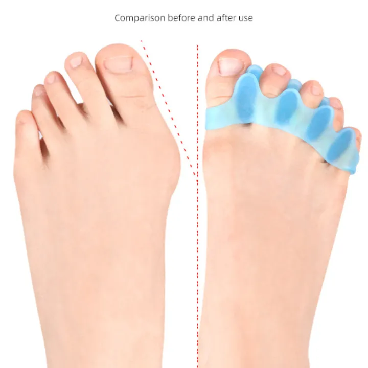2Pairs%20Hammer%20Toe%20Separators%20Silicone%20Gel%20Thumb%20Valgus%20Corrector%20Splitter%20Protector%20Straighten%20Bunion%20Adjuster%20Foot%20Pain%20Relief%20-%20Image%202