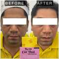 Turmeric & Kojic Acid Kem Cot Thai Whitening Soap -100gm Premium. 