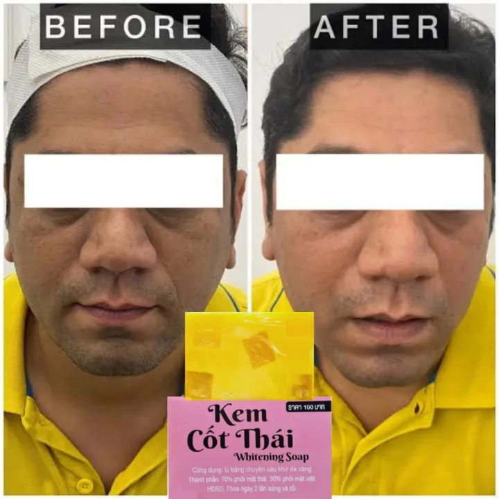 Turmeric%20&%20Kojic%20Acid%20Kem%20Cot%20Thai%20Whitening%20Soap%20-100gm%20Premium%20-%20Image%205