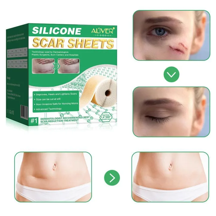 Silicone%20Scar%20Sheets%20Patch%20Painless%20Scar%20Repair%20Tape%20Roll%20Effective%20Scar%20Removal%20Strips%20For%20C-Section%20Keloid%20Surgery%20Burn%20A%20H8K5%20-%20Image%204