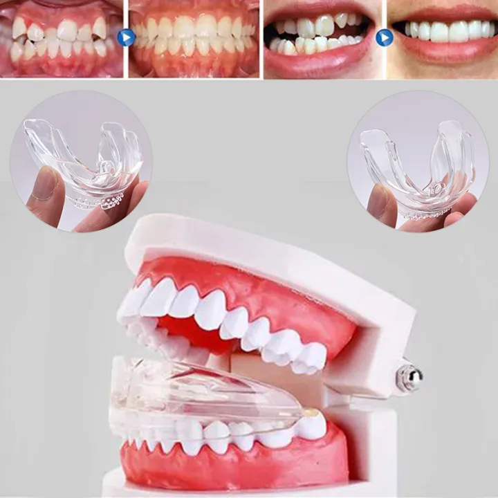 D1%20Dental%20Braces%20Orthodontic%20Tooth%20Alignment%20Tool%20Teeth%20Grinding%20Guards%20Tool%20Creek%20-%20Image%202