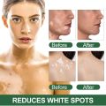 Sumifun Vitiligo Care Cream, Vitiligo Treatment, Reduces White Spots on Skin, Pigmentation regulating 20G. 