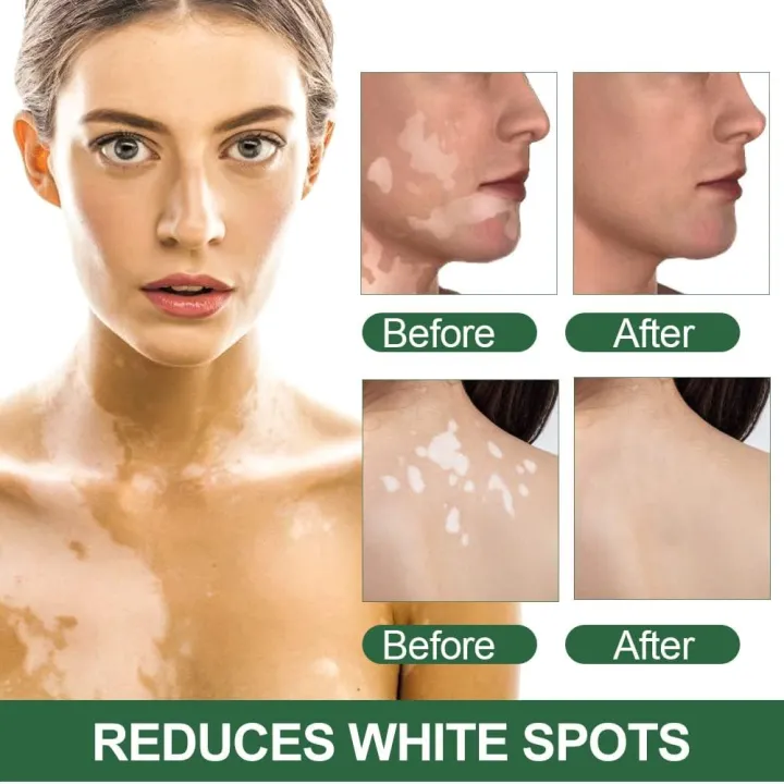 Sumifun%20Vitiligo%20Care%20Cream,%20Vitiligo%20Treatment,%20Reduces%20White%20Spots%20on%20Skin,%20Pigmentation%20regulating%2020G%20-%20Image%202
