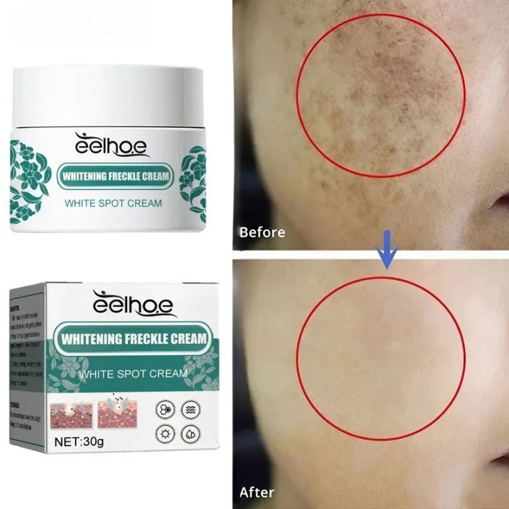 Melasma Removal Cream Niacinamide Brightening Reduce Melanin Facial Cream Lighten Dark Skin Shrink Pores Moisturizer Skin Care