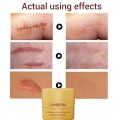 LANBENA Acne Scar Removal Face Treatment Cream Stretch Marks Repair Remove Acne Spots Fade Scar Melanin Moisturizing Smooth Skin-40GM. 