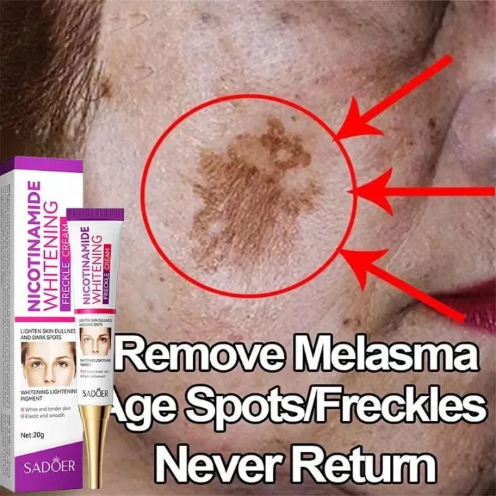 Melasma%20Remover%20Cream%20Removal%20Dark%20Pigment%20Brighten%20Cream%20Face%20Fade%20Melanin%20Cream%20Nicotinamide%20Brightening%20Moisturizing%20Emulsion%20-%20Image%202