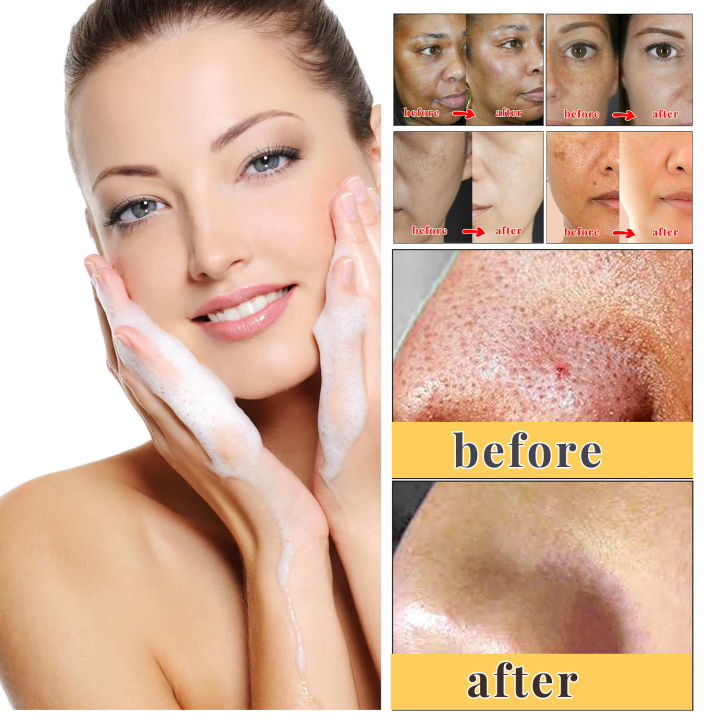 Kojic%20Acid%20Skin%20Care%20Set%20Facial%20Cleanser%20Body%20Lotion%20Handmade%20Soap%20Remove%20Dark%20Spots%20Whitening%20Anti%20Aging%20Remove%20Acne%20Body%20Care%20-%20Image%205