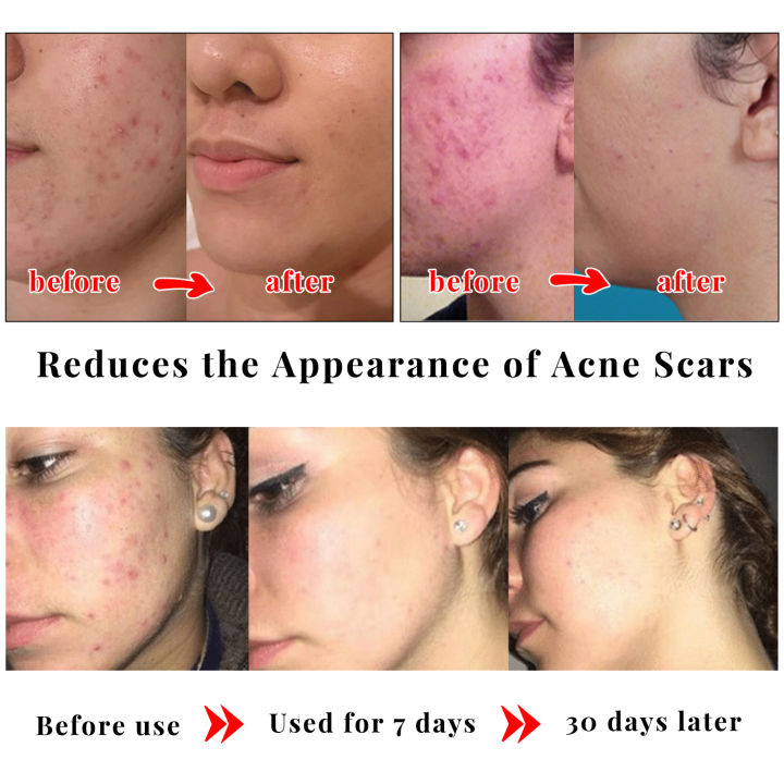 Kojic%20Acid%20Skin%20Care%20Set%20Facial%20Cleanser%20Body%20Lotion%20Handmade%20Soap%20Remove%20Dark%20Spots%20Whitening%20Anti%20Aging%20Remove%20Acne%20Body%20Care%20-%20Image%202