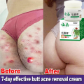 White Cream, Moisturizing Skin, Chicken Repair Cream, Buttocks, Back Acne, Body Acne Cream, Facial Sores, Smooth Marks.