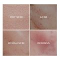 Fenyi Green Tea Nourishing Acne Repair Essence Cream- 40g.