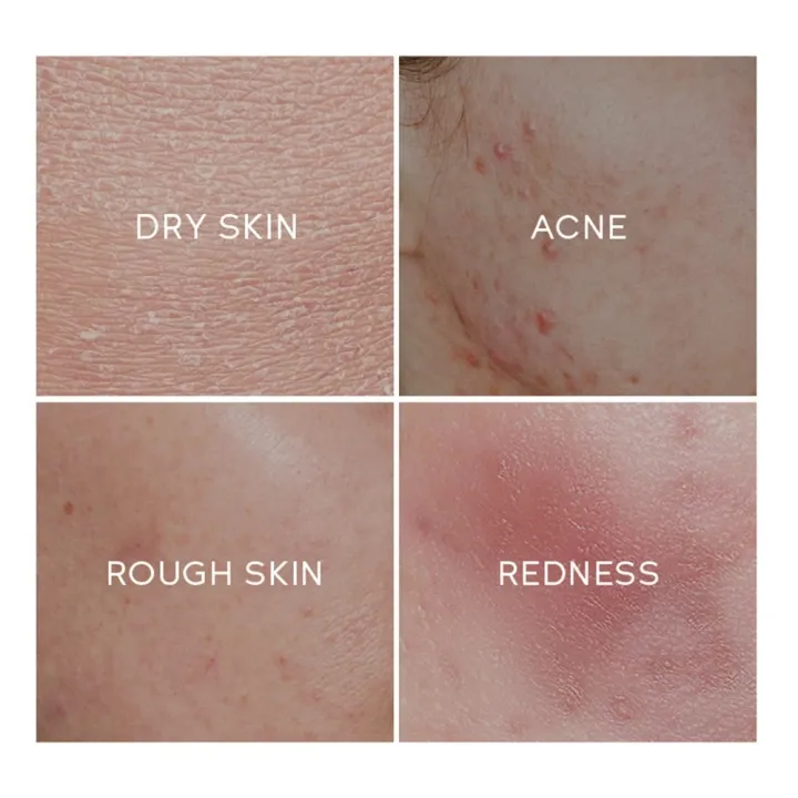 Fenyi%20Green%20Tea%20Nourishing%20Acne%20Repair%20Essence%20Cream-%2040g%20-%20Image%205