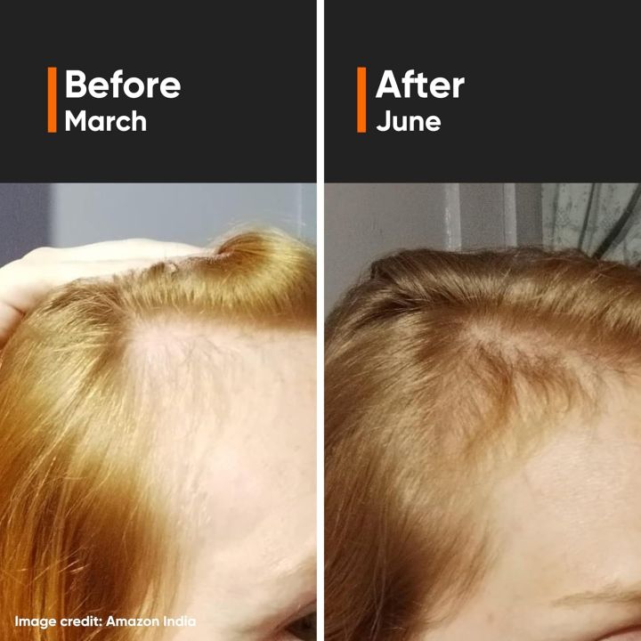 Minimalist%20Hair%20Growth%20Active%2018%25%20Serum%2030ml%20With%203%25%20Redensyl,%203%25%20Anagain,%203%25%20Procapil,%205%25%20Capixyl%20&%204%25%20Baicapil%2018%25%20Hair%20Growth%20Actives%20%7C%20For%20Hair%20Fall%20Control%20%7C%20For%20Men%20&%20Women%20-%20Image%208