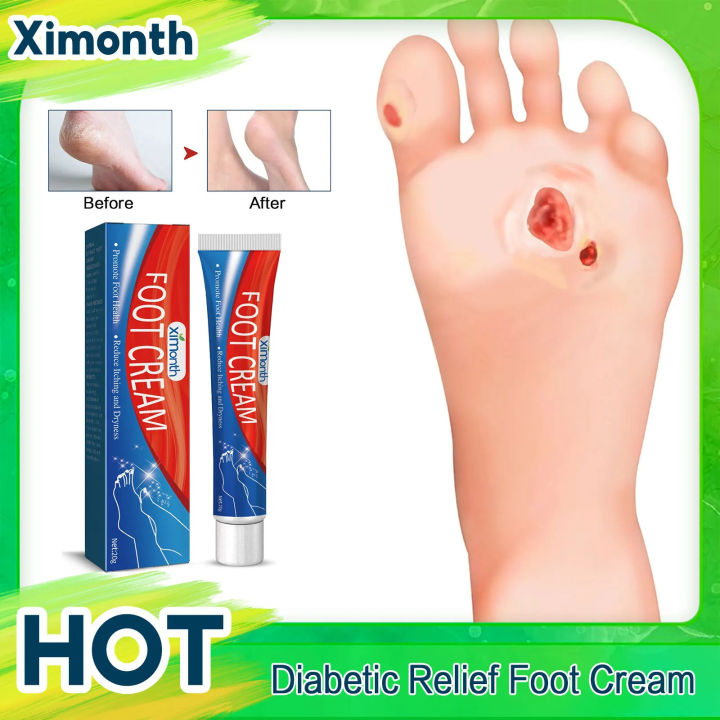 Diabetes Treatment Foot Cream Repair Feet Ulceration Relieve