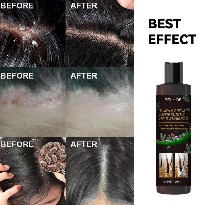 EELHOE%20100ml%20Tinea%20Dispelling%20Anti-itching%20Shampoo%20Anti-dandruff%20Shampoo%20Hair%20Shampoo%20Treatment%20Oil%20Refreshing%20Control%20-%20Image%206
