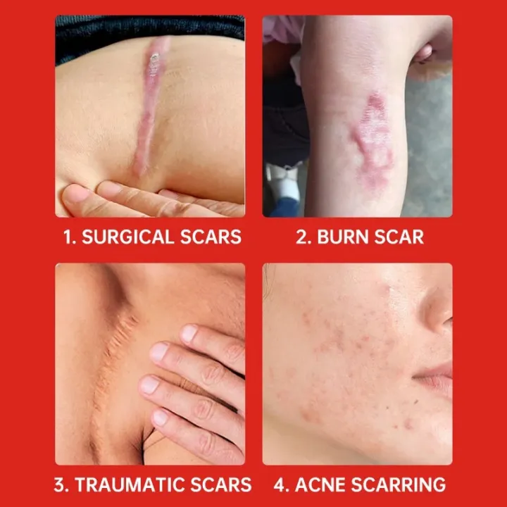 Fast%20Scar%20Removal%20Cream%20Effective%20Treatment%20Stretch%20Marks%20Burn%20Surgical%20Scars%20Acne%20Spots%20Repair%20Whitening%20Moisturizing%20Skin%20Care%20-%20Image%203