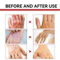 Psoriasis Treatment Cream Antibacterial Dermatitis Eczema Therapy Relieve Rash Urticaria Skin Herbal Skin Anti Itch Ointment 30g.