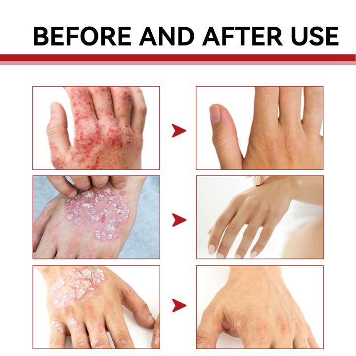 Psoriasis%20Treatment%20Cream%20Antibacterial%20Dermatitis%20Eczema%20Therapy%20Relieve%20Rash%20Urticaria%20Skin%20Herbal%20Skin%20Anti%20Itch%20Ointment%2030g%20-%20Image%206