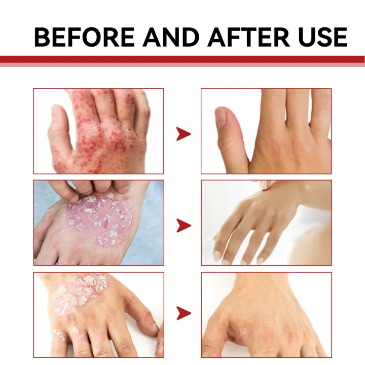 Psoriasis%20Treatment%20Cream%20Antibacterial%20Dermatitis%20Eczema%20Therapy%20Relieve%20Rash%20Urticaria%20Skin%20Herbal%20Skin%20Anti%20Itch%20Ointment%2030g%20-%20Image%206