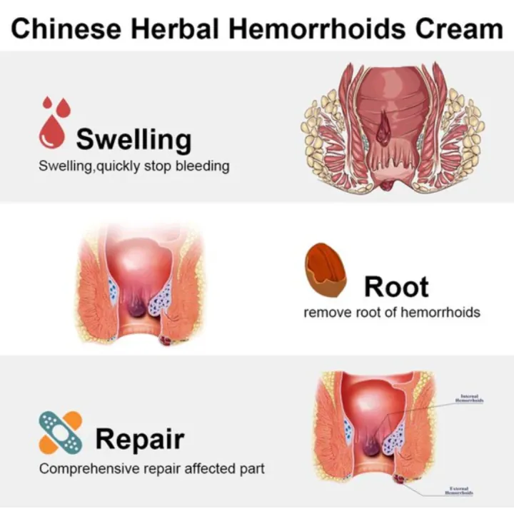 Dictamni%20Herbal%20Cream%20for%20Hemorrhoids%2020%20G%20Hemorrhoids%20Cream%20Hemorrhoids%20Relief%20Cream%20Hemorrhoids%20Healing%20Cream%20-%20Image%202