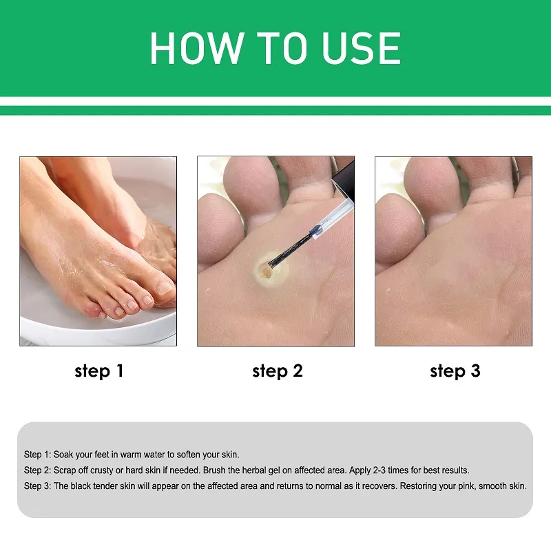 Before And After Best Way To Get Rid Of Corns On Feet Effective