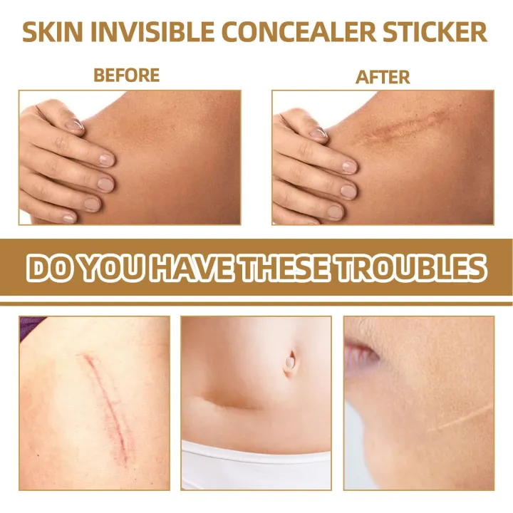 Invisible%20Concealer%20Sticker%20Skin%20Color%20Concealer%20Tattoo%20Stickers%20Cover%20Up%20Burn%20Scar%20Birthmark%20Invisible%20Patch%20Waterproof%20Tape%20-%20Image%205