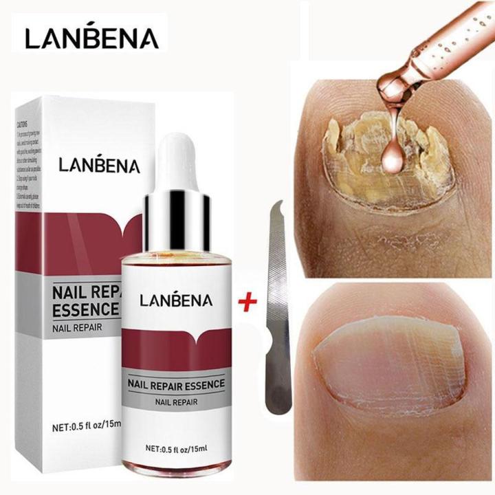 LANBENA Nail Repair Essence Serum Fungal Nail Treatment Remove Onychomycosis Toe Nourishing Brighten Hand Foot Skin Care 12ml