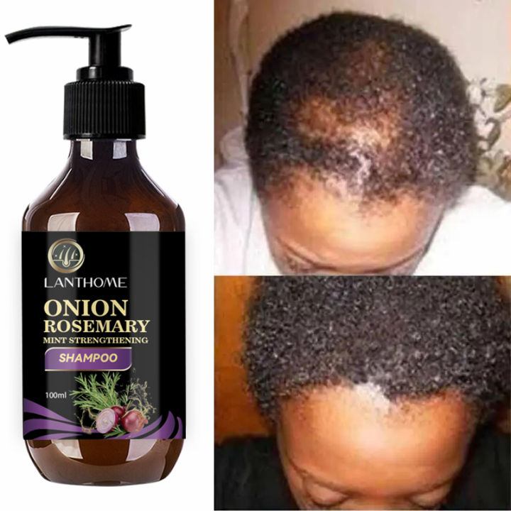 Hair%20Shampoo%20For%20Fast%20Hair%20Growth%20Rosemary%20Onion%20Hair%20Regrowth%20Shampoo%20Anti%20Hair%20Loss%20Effective%20Within%207%20Day%20Hair%20Growth%20Product%20-%20Image%203