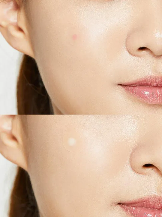 Cosrx%20Acne%20Pimple%2024%20Master%20Patches-1%20set%20-%20Image%202
