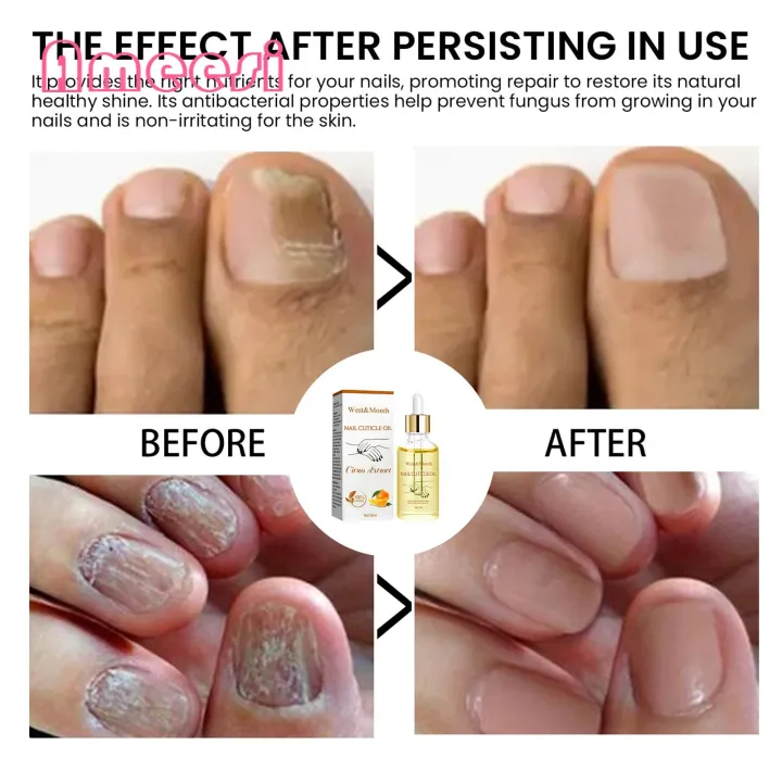 Nail%20Strengthening%20Oil%2015ml%20Nail%20Strengthening%20Cuticle%20Oil%20Repair%20Damaged%20Nails%20Moisturize%20Cuticles%20Natural%20Ingredients%20Fast%20Results%20Damaged%20Nail%20Repair%20Oil%20-%20Image%204