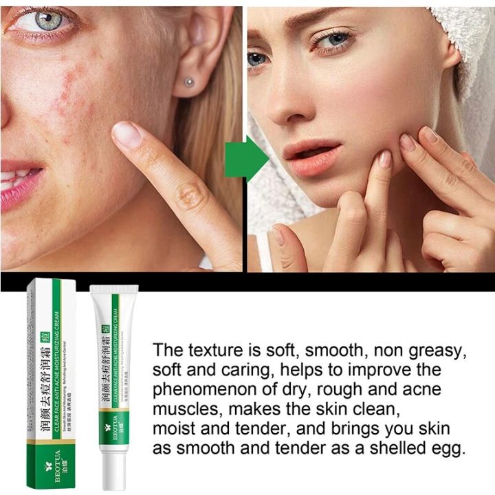 Aloe%20Vera%20Gel%20Anti%20Acne%20Treatment%20Pimples%20And%20Acne%20Remover%20Cream%20Facial%20Moisturizer%20Glowing%20Skin%20Korean%20Skin%20Care%20Products%2020g%20-%20Image%205