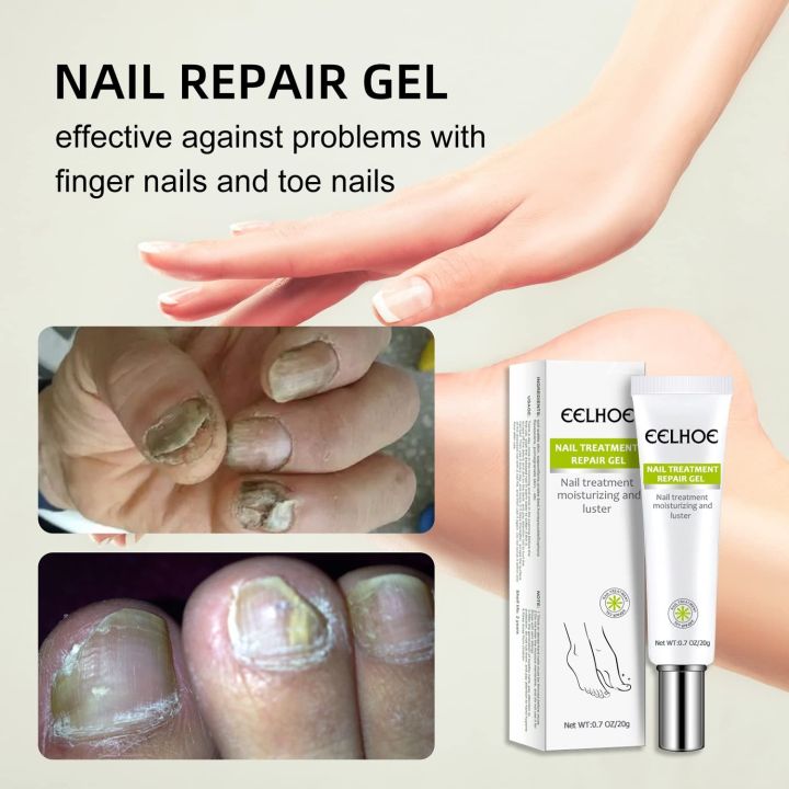 Efero%20Nail%20Repair%20Treatment%20Gel%20Fungus%20Cream-20gm%20-%20Image%202