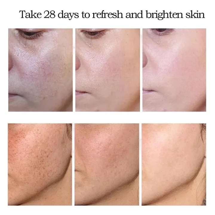 Face%20Dark%20Spots%20Remover%20for%20Women%20Remove%20Melasma%20Freckles%20Cream%20Removal%20Melanin%20Whitening%20Cream%20Fade%20Spots%20Skin%20Brightening%20Care%20-%20Image%206