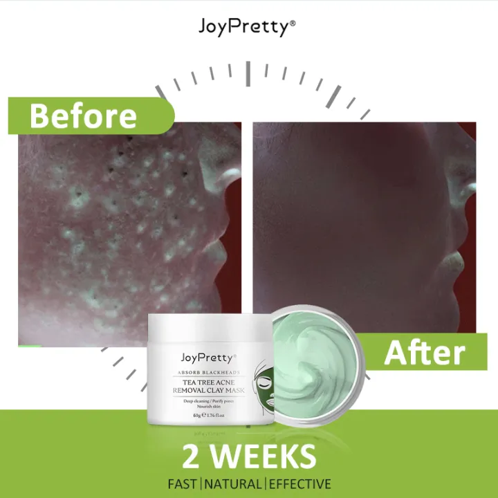 Acne%20Treatment%20Facial%20Mask%20Natural%20Tea%20Tree%20Pore%20Cleaning%20Blackhead%20Remove%20Oil%20Control%20Pimple%20Skin%20Care%20Products%20Face%20Clay%20Mask%20KKhao%20-%20Image%205