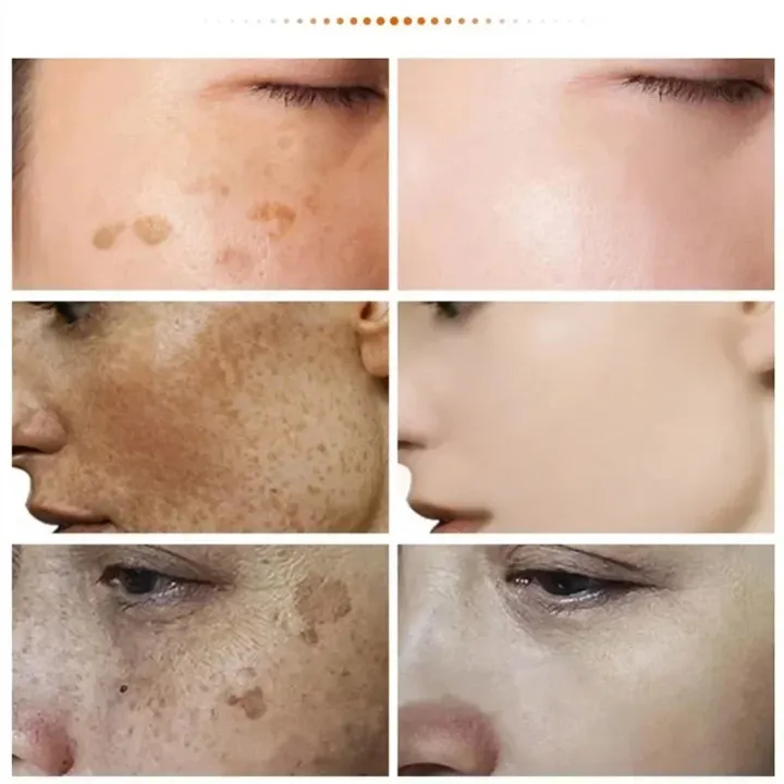 Melasma%20Removal%20Cream%20Niacinamide%20Brightening%20Reduce%20Melanin%20Facial%20Cream%20Lighten%20Dark%20Skin%20Shrink%20Pores%20Moisturizer%20Skin%20Care%20-%20Image%205