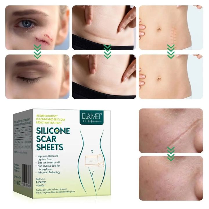 %E3%80%90Sleek%E3%80%91%20Scar%20Sheets%20Patch%20Painless%20Scar%20Repair%20Tape%20Roll%20Effective%20Scar%20Removal%20Strips%20For%20C-Section%20Keloid%20Surgery%20Burn%20Acne%20-%20Image%207