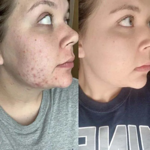 CeraVe%20Acne%20control%20cleanser%20237ml%20-%20Image%202