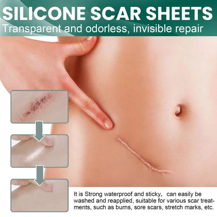 1%20Roll%20Surgery%20Scar%20Removal%20Silicone%20Gel%20Sheet%20Patch%20Tape%20Sticker%20Skin%20Repair%20-%20Image%202