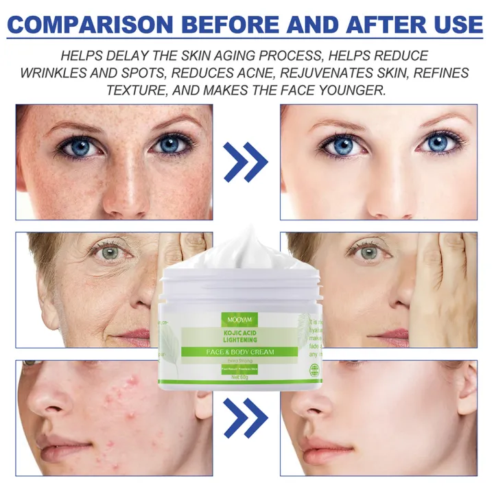 Kojic%20Acid%20Face%20Cream%20Whitening%20Remove%20Freckles%20Dark%20Spots%20Anti%20Aging%20Brighten%20Moisturizing%20Nourishing%20Korean%20Skin%20Care%20Health%20-%20Image%202