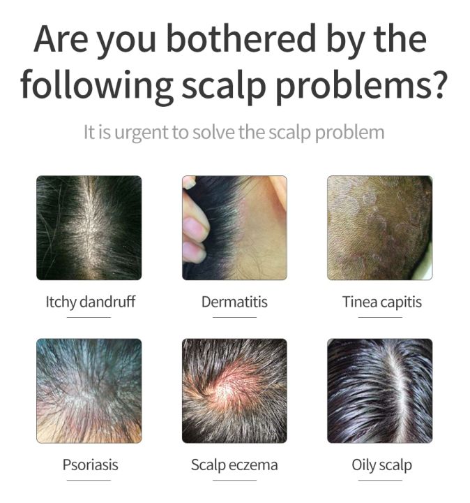 Treatment%20Of%20Psoriatic%20Seborrheic%20Dermatitis%20With%20Anti%20Tinea%20Capitis%20And%20Anti%20Itching%20Shampoo%20Anti%20Dandruff%20And%20Oil%20Control%20Hair%20-%20Image%204